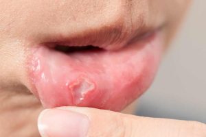 6 Tips Cara Mengatasi Sariawan pada Anak yang Perlu Diketahui Orang Tua